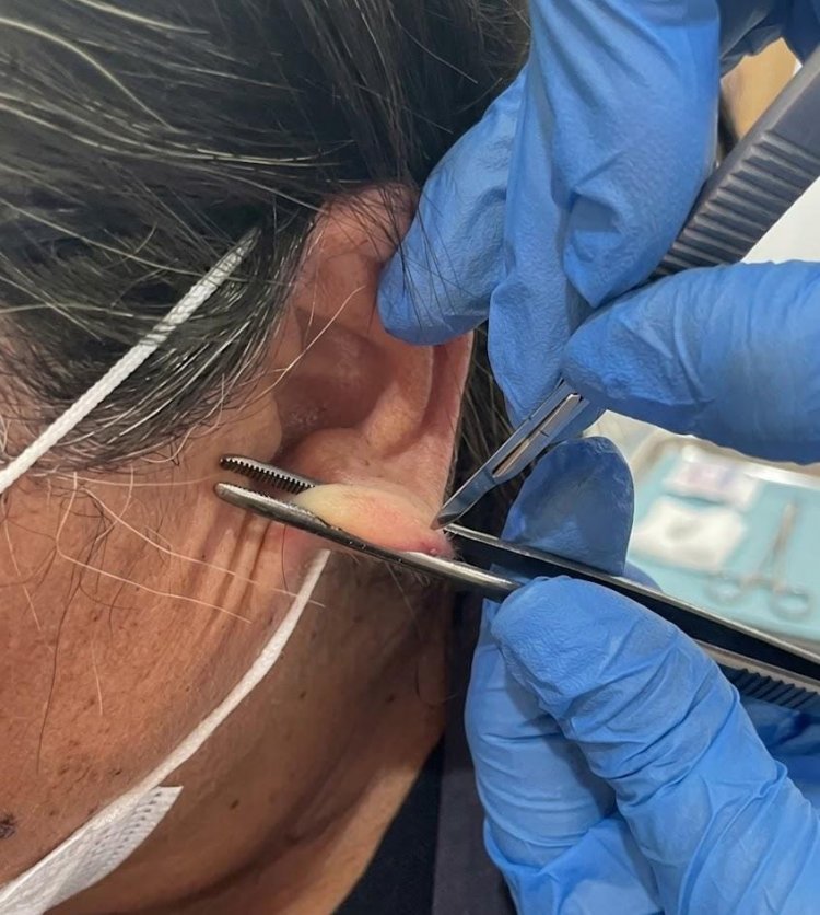 Saúde itinerante de Floriano leva atendimento à comunidade L3 em ação de combate à hanseníase